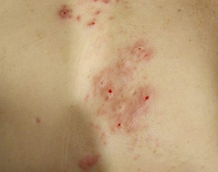 50대 여성분 대상포진 치료사례