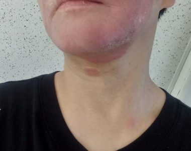 50대 여성 주사피부염 치료 사례