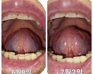 70대 남성 대상포진과 불면증 치료사례
