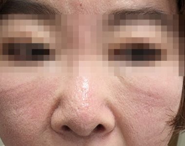 50대 여성분 역류성식도염으로 인한 기침 치료 사례
