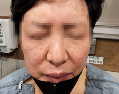 50대 여성 환자분 돼지고기 먹고 올라온 피부발진 치료 사례