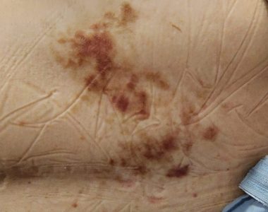 70대 남성 대상포진 치료 사례