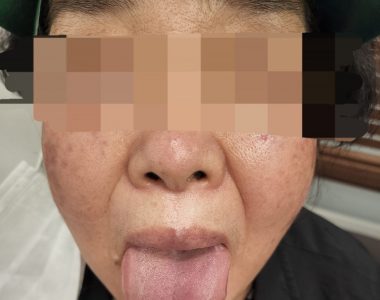 60대 여성분 대상포진 치료 사례