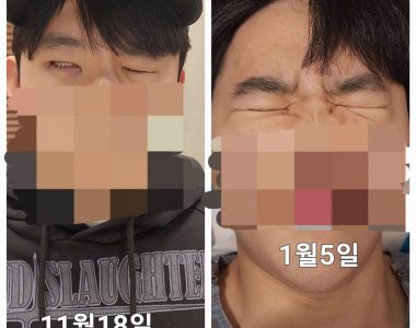 20대 남성 얼굴 대상포진 이후 안면마비, 이명, 어지럼증 치료 사례