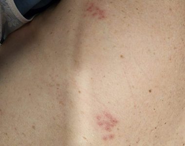 80대 여성분 대상포진 치료사례