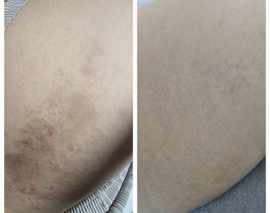 30대 여성 허벅지 안쪽 난치성 습진 치료 사례