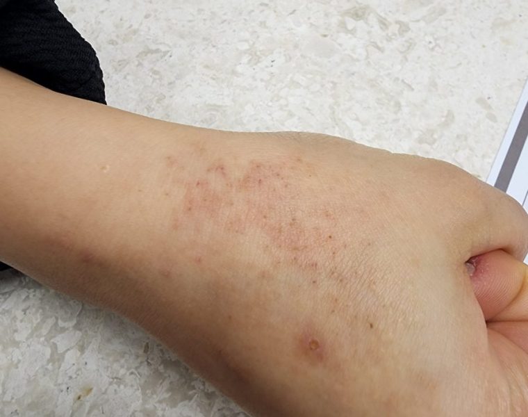 20대 여성분 스트레스로 인한 접촉성 피부염 가려움증 치료 사례