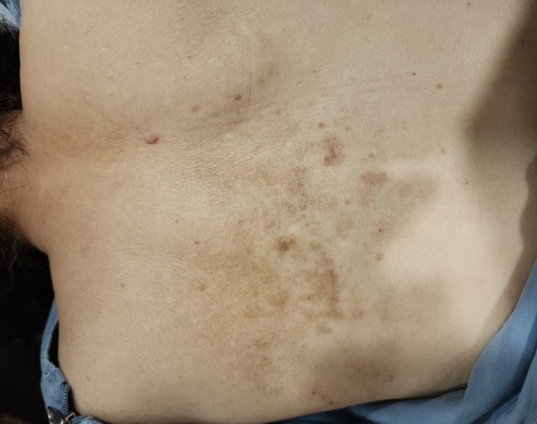 마약성 진통제가 듣지 않던 80대 여성분  대상포진 치료 사례