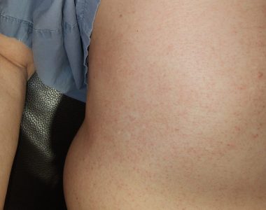 70대 남성 피부발진