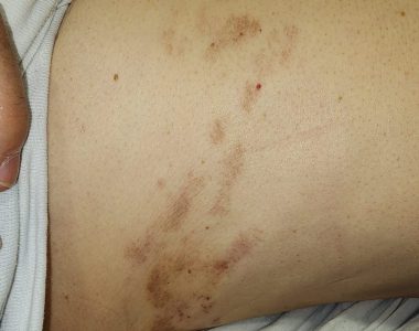 60대 여성분 대상포진 치료 사례