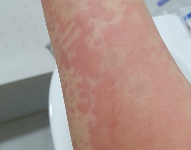 50대 여성분 극심한 두드러기, 두통, 수면장애
