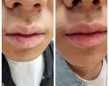 20대 남성 눈, 입술 주변 아토피 치료사례