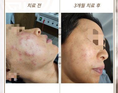 지루성 피부염으로 내원하신 60대 여성입니다