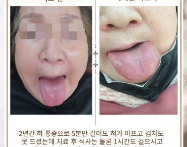 혀통증으로 내원하신 70대 여성입니다