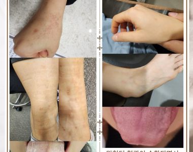 전신 가려움증으로 내원하신 20대여성입니다