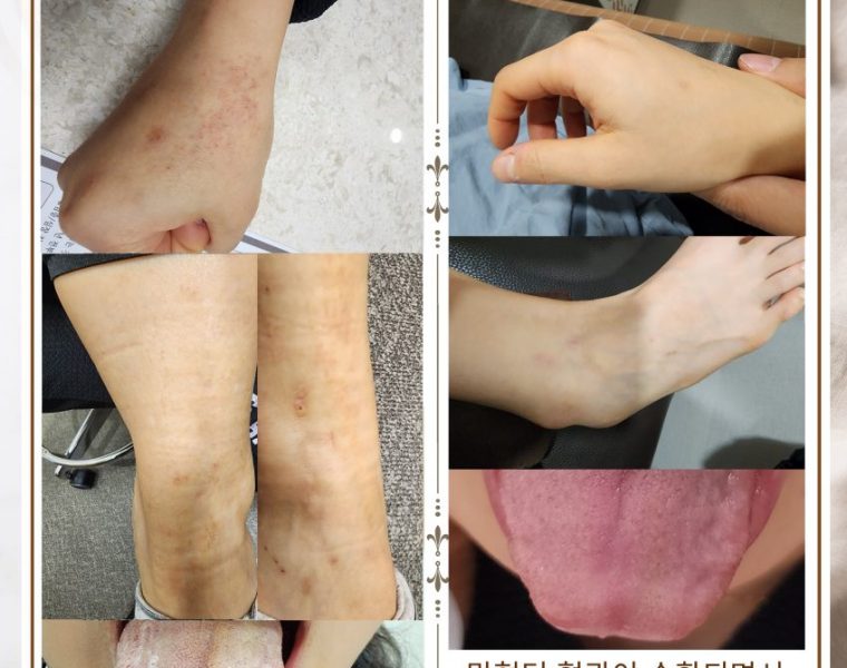 전신 가려움증으로 내원하신 20대여성입니다