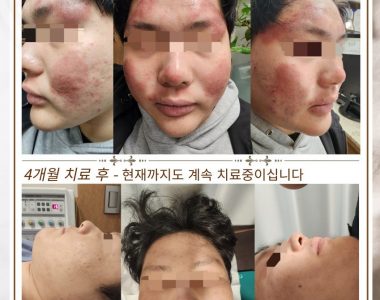 전신 아토피로 내원하신 20대 남성입니다