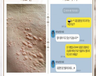 콜린성두드러기로 내원하신 40대 남성입니다