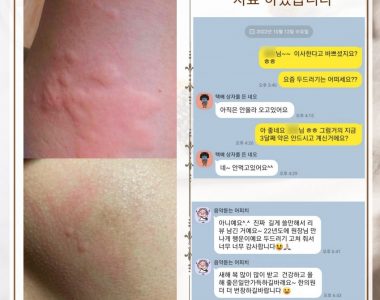 두드러기로 내원하신 30대 여성입니다