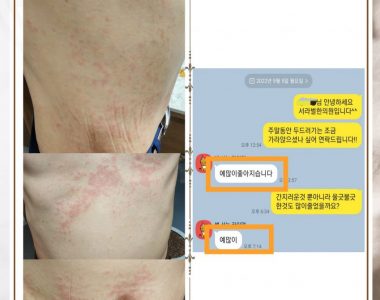 두드러기로 내원하신 50대 남성입니다