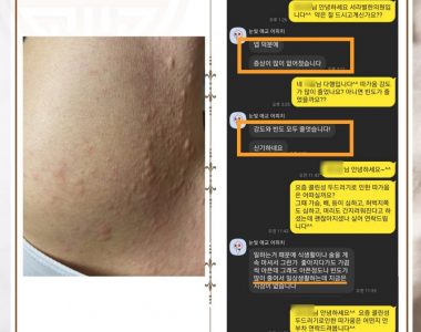 콜린성 두드러기로 내원하신 30대 남성입니다