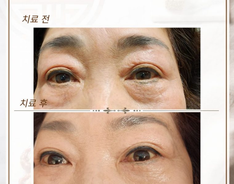 눈두덩이가 부워서 내원하신 60대 여성입니다