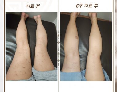 전신두드러기로 내원하신 20대 여성입니다