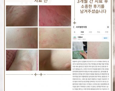 두드러기로 내원하신 20대 여성입니다