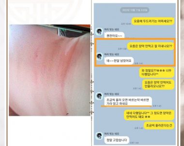 만성두드러기로 내원하신 50대 여성입니다