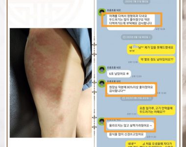 전신두드러기/수면장애로 내원하신 50대 여성입니다