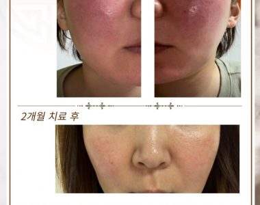 안면홍조/화끈거림/가려움으로 내원하신 30대 여성입니다