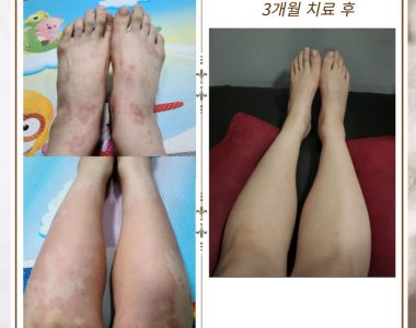 만성두드러기로 내원하신 40대 여성입니다