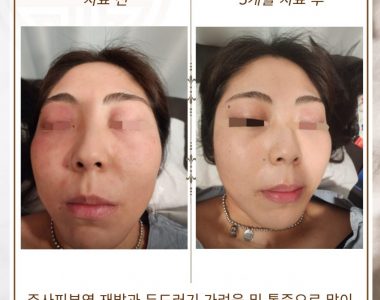 주사피부염으로 내원하신 30대 여성입니다