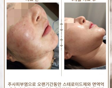 주사피부염으로 내원하신 30대 여성입니다