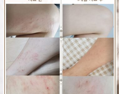 두드러기로 인해 잠을 못 주무시던 40대 여성입니다