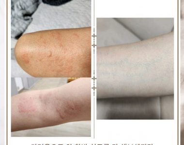 두드러기로 내원하신 60대 여성입니다