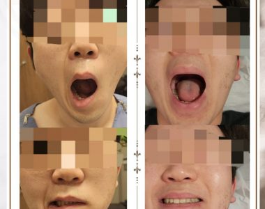 안면마비로 내원하신 20대 남성입니다(24.02.06)