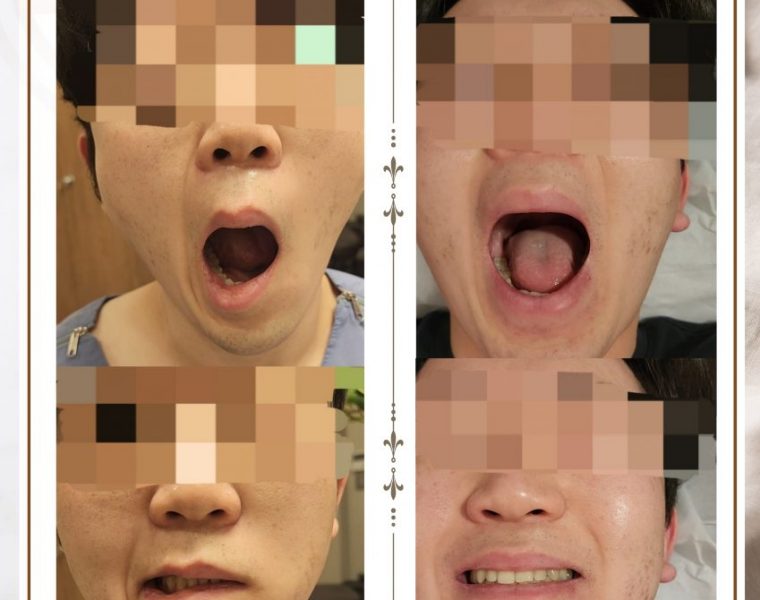 안면마비로 내원하신 20대 남성입니다(24.02.06)