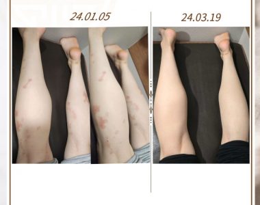 두드러기로 내원하신 30대 여성입니다(24.03.19)