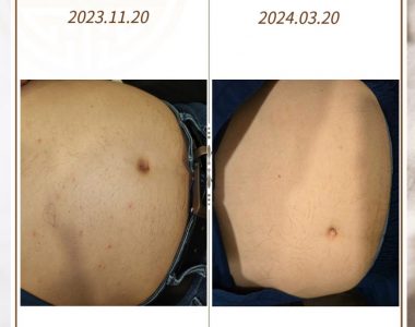 피부가려움증으로 내원하신 60대 남성입니다(24.03.20)