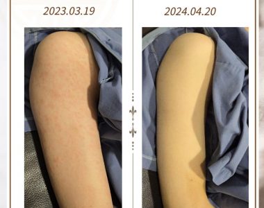 두드러기로 거제도에서 내원하신 10대 남성입니다(24.04.20)