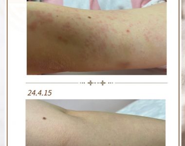 두드러기로 내원하신 20대 여성입니다(24.04.15)