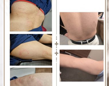 두드러기로 내원하신 50대 남성입니다.