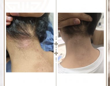 아토피성 피부염으로 내원하신 30대 남성입니다.