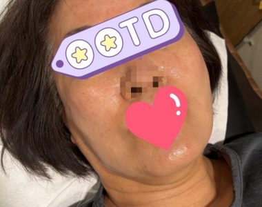 난치성 얼굴 피부병