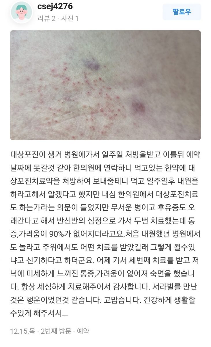 대상포진