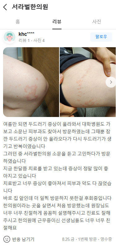 두드러기 치료후기