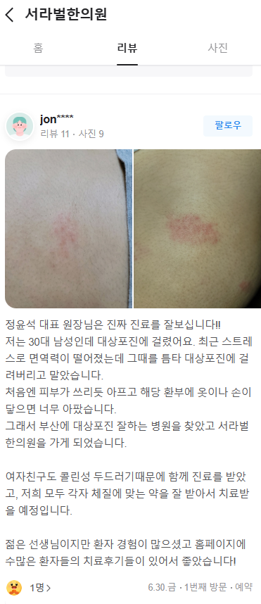 대상포진 치료후기