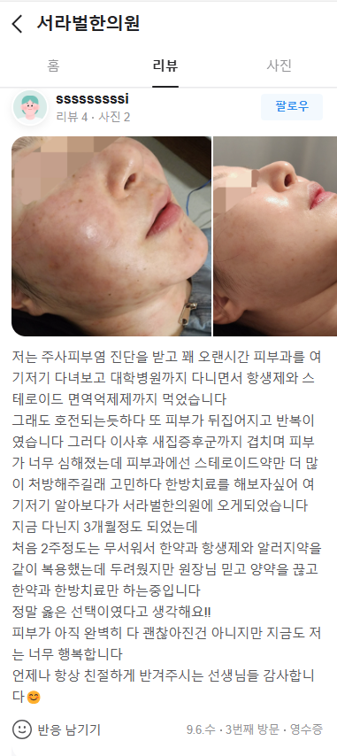 주사피부염 치료후기