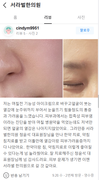 접촉성피부염 치료후기